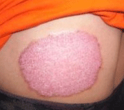 じんじょうせいかんせん