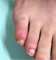 凍瘡（しもやけ）