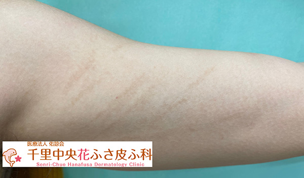 しいたけ皮膚炎