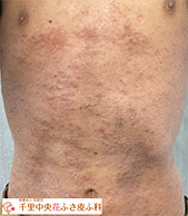 アトピー苔癬化