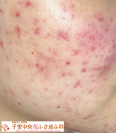 ニキビ治療before