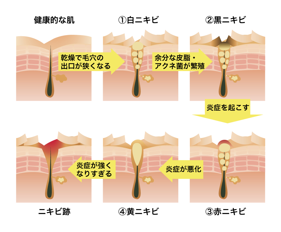 ニキビの経過