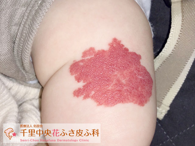 Vbeam 6回照射 施術前