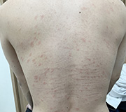 ジベルバラ色粃糠疹